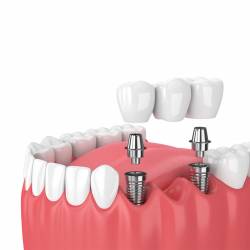 Best dentist in Gorakhpur, Dentist in Gorakhpur, Dental Hospital in Gorakhpur, Dental clinic in Gorakhpur, Esthetic dentist in Gorakhpur, Best dental surgeon in Gorakhpur, Dental Implants Doctors in Gorakhpur, Best dental clinic in Gorakhpur